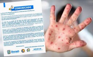 ANCASH: CONFIRMAN UN CASO DE SARAMPIÓN IMPORTADO EN NUEVO CHIMBOTE.